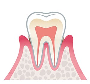 歯周炎（軽度）