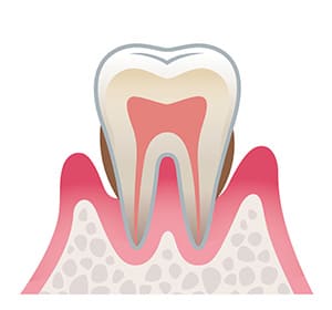 歯周炎（中等度）