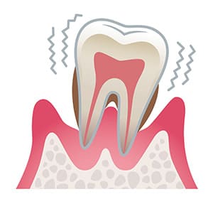 歯周炎（重度）