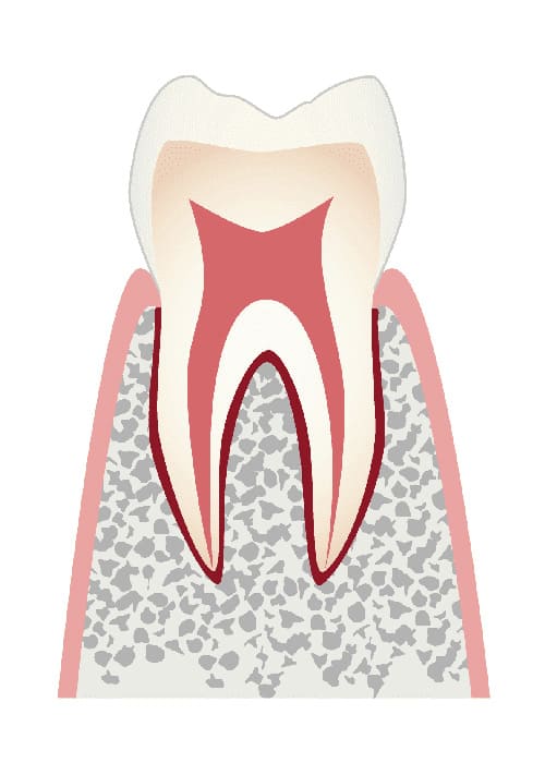 CO：初期の虫歯